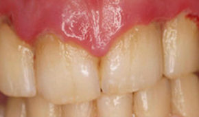 Periodoncia